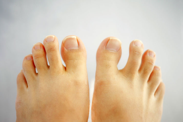 水虫(足・爪白癬)のイメージ画像