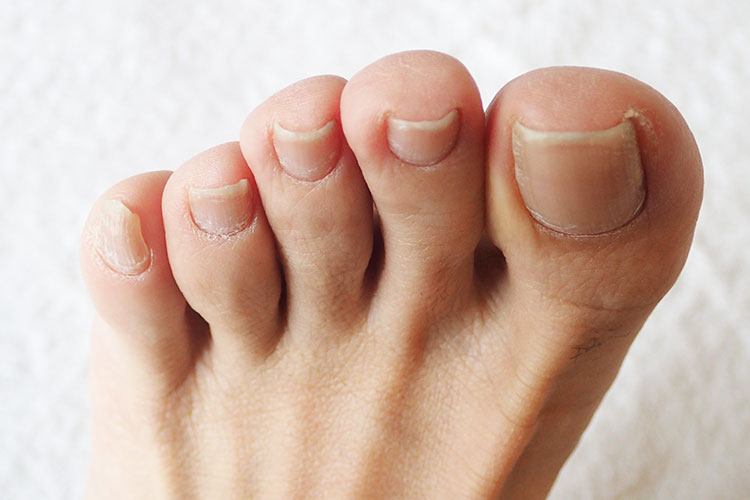 巻き爪のイメージ画像